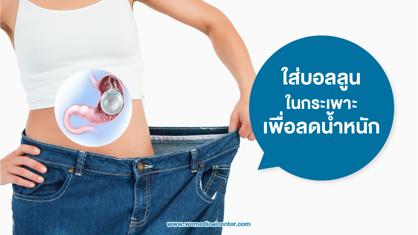 intragastric-balloon